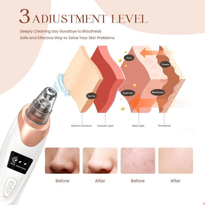 Electric 5-in-1 Acne & Blackhead Remover