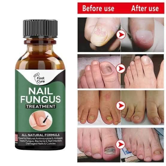 Nail Fungal Treatment Gel