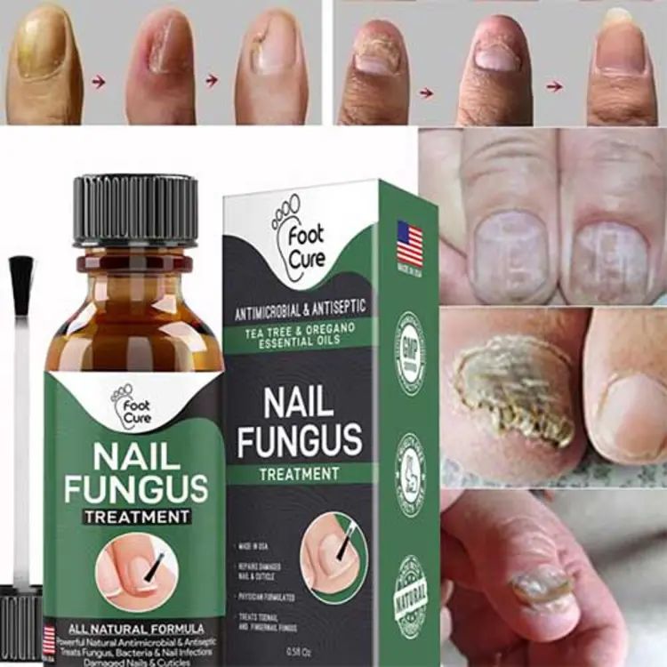 Nail Fungal Treatment Gel